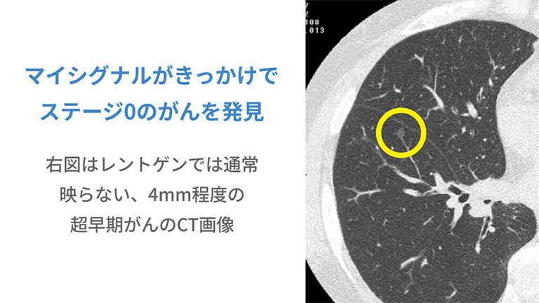 マイシグナルがきっかけでステージ0のがんを発見 右図はレントゲンでは通常映らない、4mm程度の超早期がんのCT画像